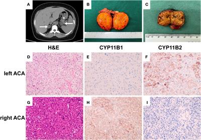 Different cell compositions and a novel somatic KCNJ5 variant found in a patient with bilateral adrenocortical adenomas secreting aldosterone and cortisol